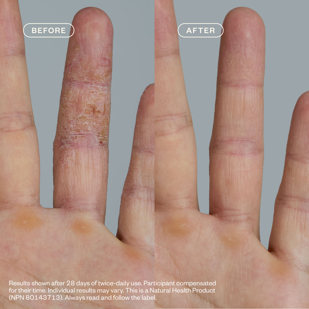 Dermedial™ Eczema+ B3